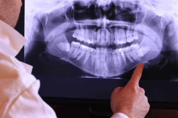 Best Emergency Wisdom Teeth Removal in Hiram, GA