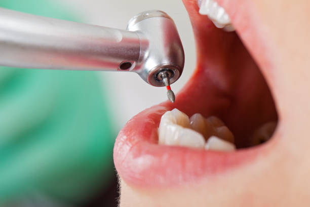 Best Emergency Treatment for Dental Infections or Abscesses in Hiram, GA